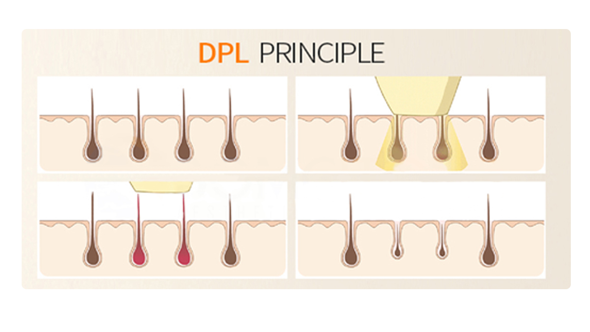 Équipement de salon de beauté DPL pour l'épilation