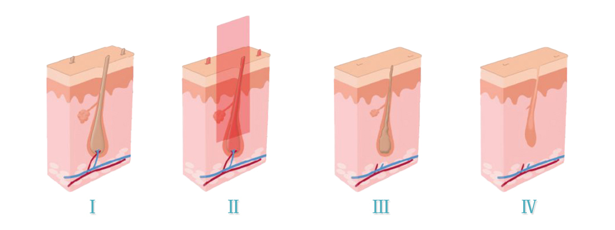 équipement de beauté ipl