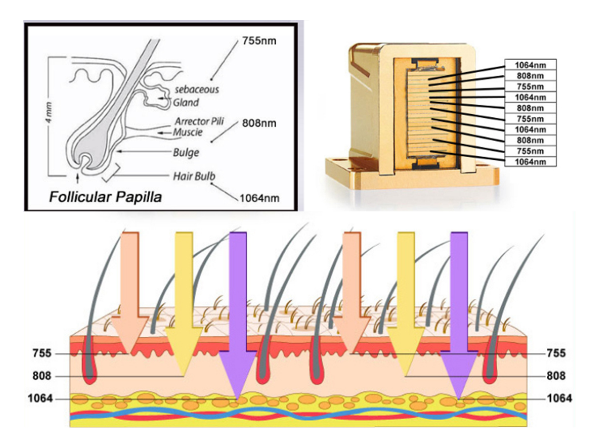 05Système d'épilation au laser à diode verticale à triple longueur d'onde