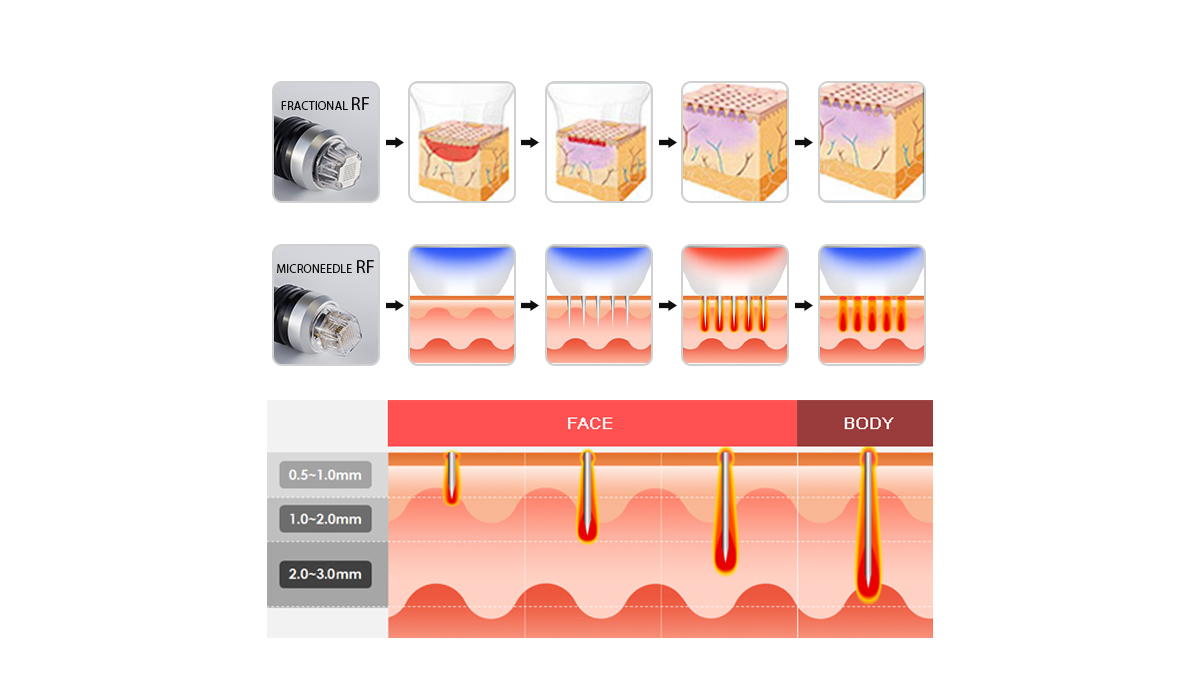 Machine RF fractionnelle à micro-aiguilles
