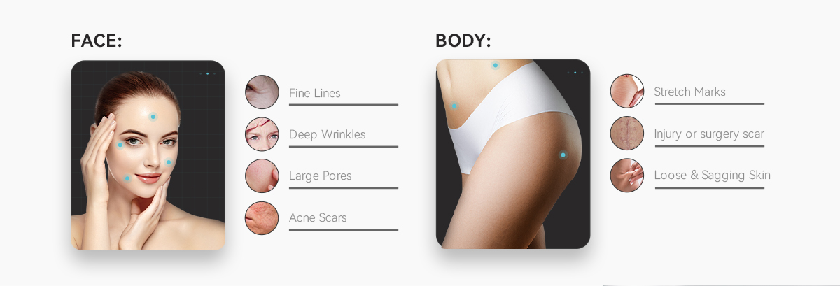 machine rf de microneedling sous vide