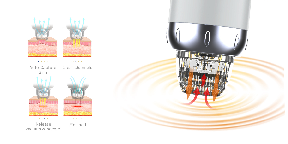 machine rf de microneedling sous vide